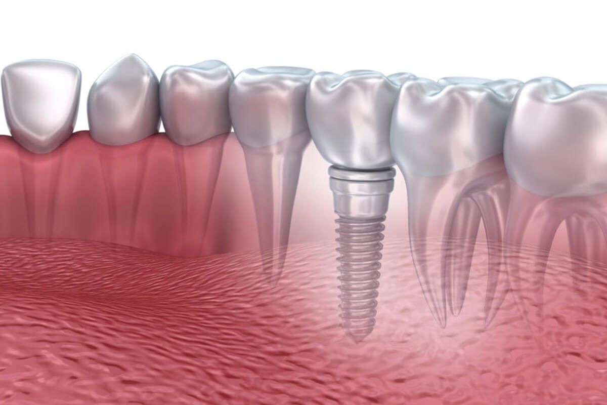 Biến chứng sau khi trồng implant
