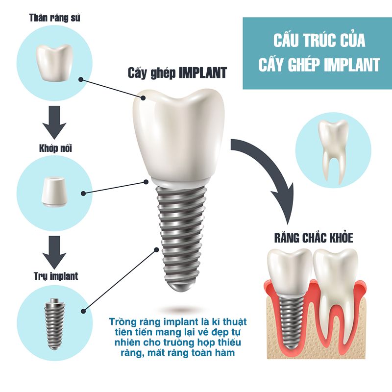 Cấu tạo implant