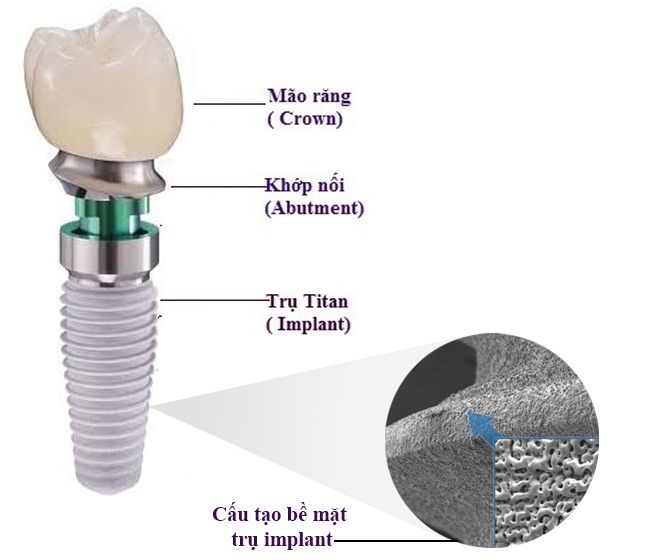 Cấu trúc răng sứ Implant
