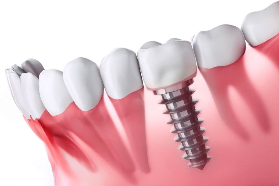Cắm trụ Implant xương hàm