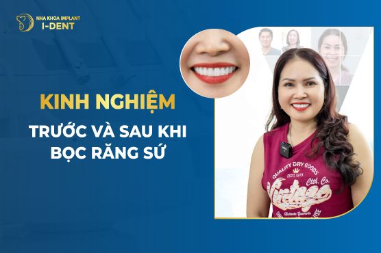 Chăm sóc răng miệng sau khi bọc răng sứ