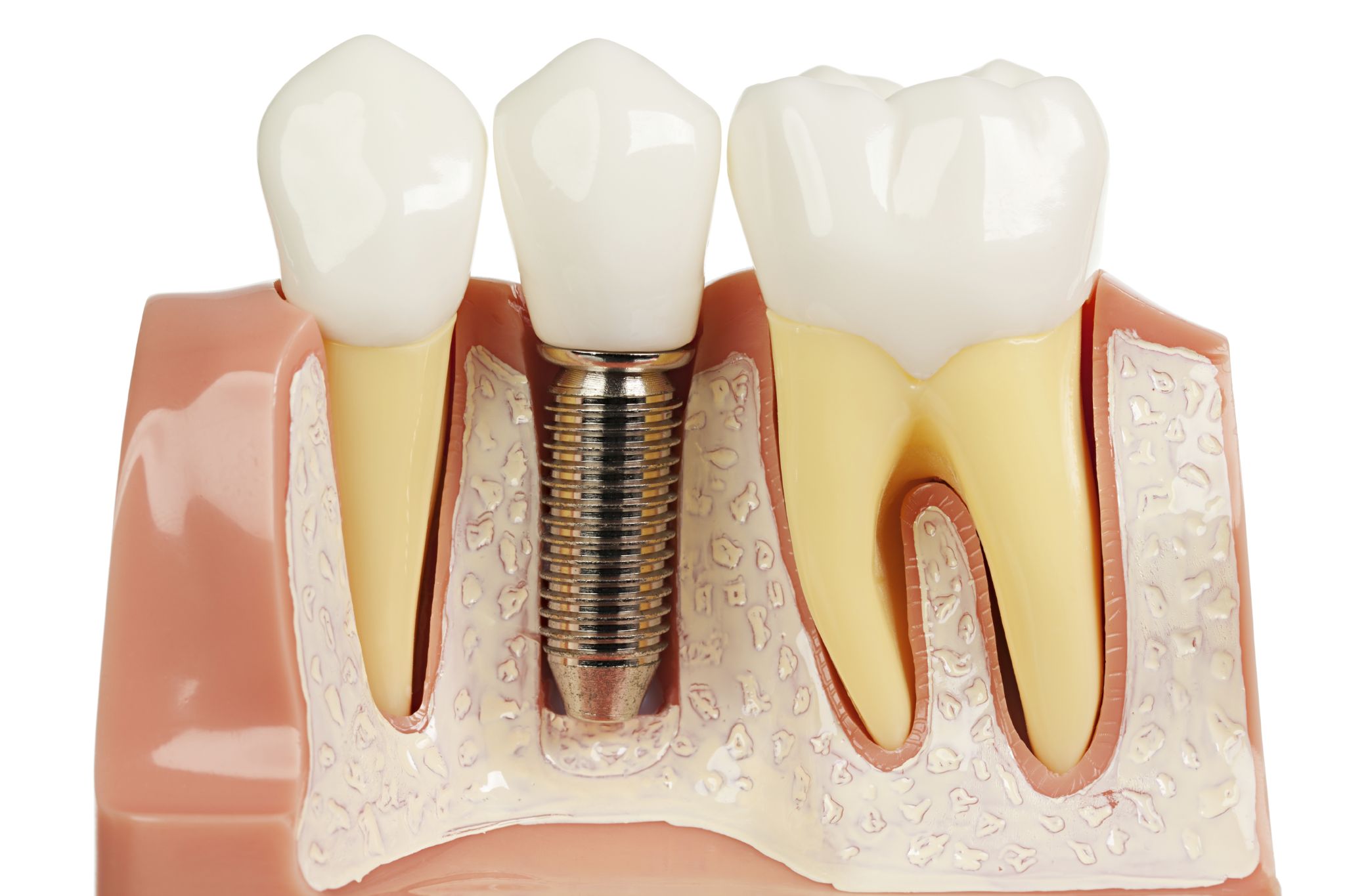 Chi phí trồng răng implant