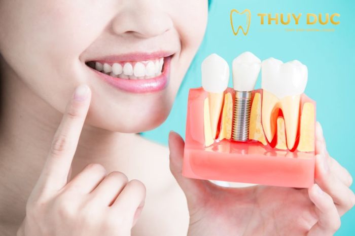 Hướng dẫn sau cấy ghép implant