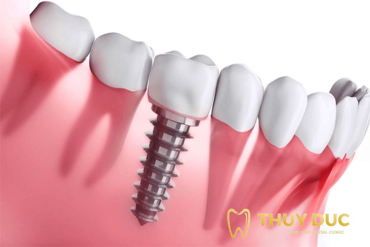 Quá trình làm răng sứ implant