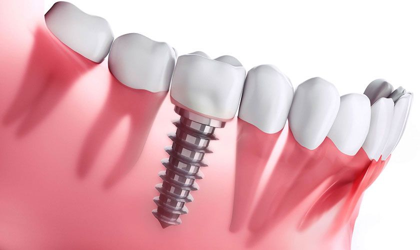 Lợi ích lâu dài của implant