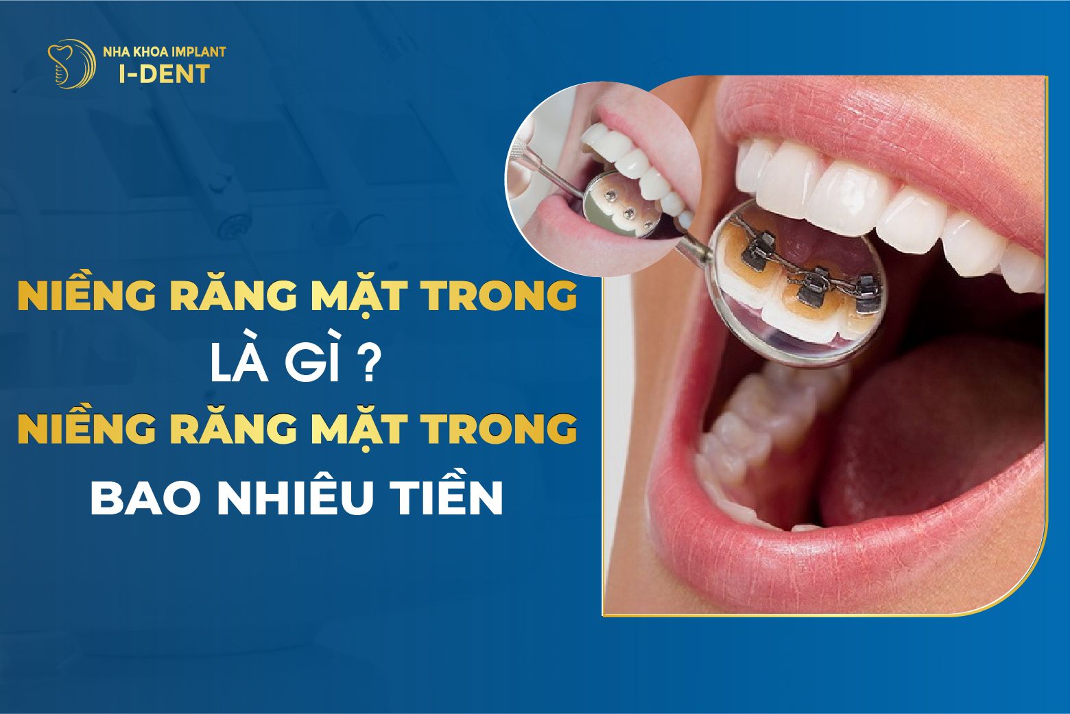 lợi ích niềng răng mặt trong