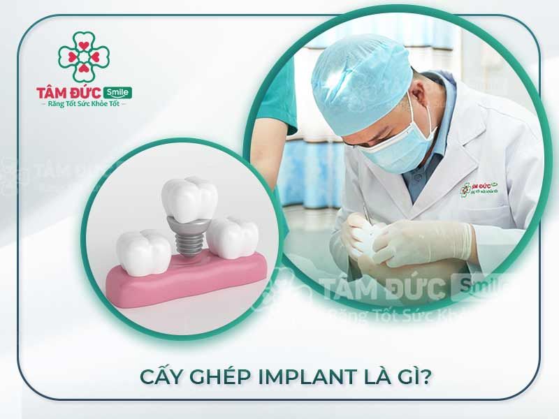 Lợi ích răng sứ Implant