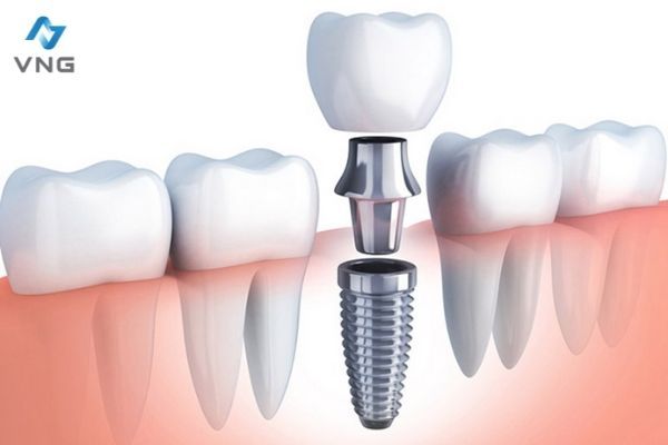 Lợi ích nổi bật của trồng răng implant