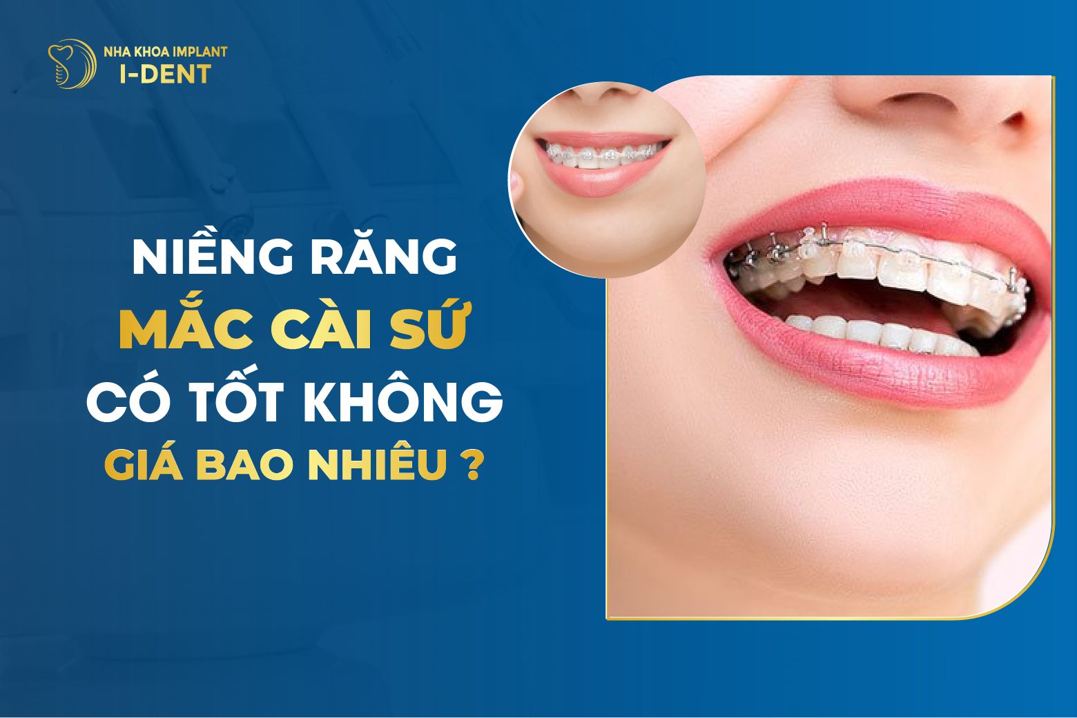 Niềng răng mắc cài sứ