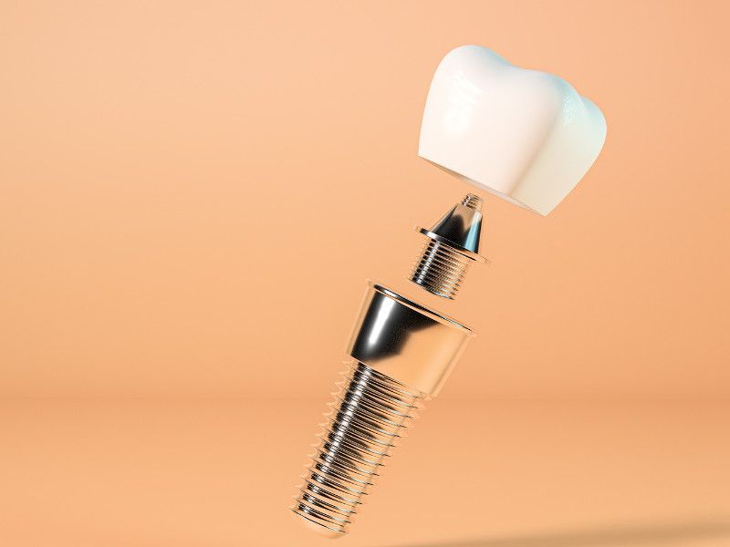 Phục hình răng implant cố định