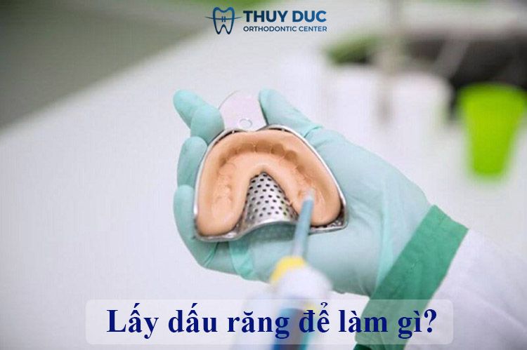 Quá trình lấy dấu răng