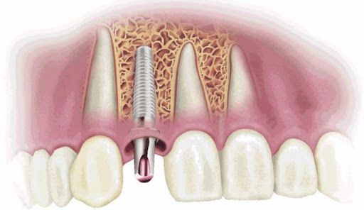 Quá Trình Tích Hợp Implant