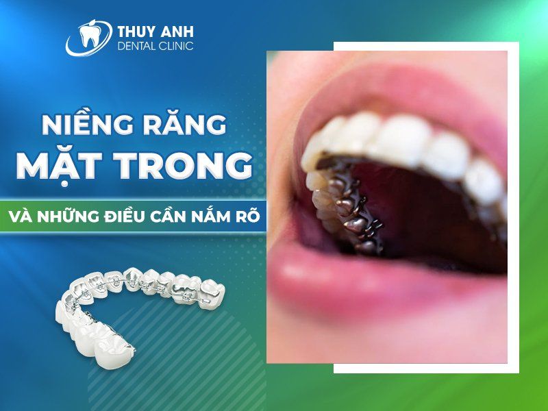 quy trình niềng răng mặt trong