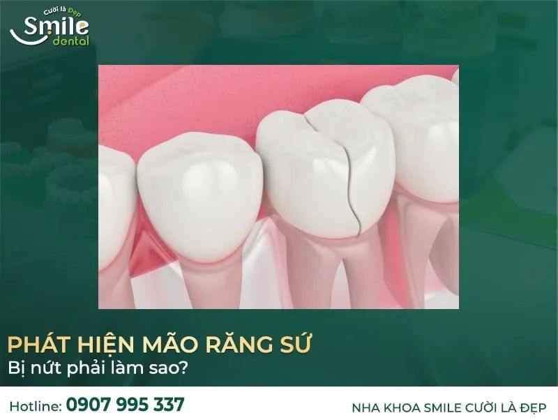 Răng sứ bị nứt, cần sửa chữa