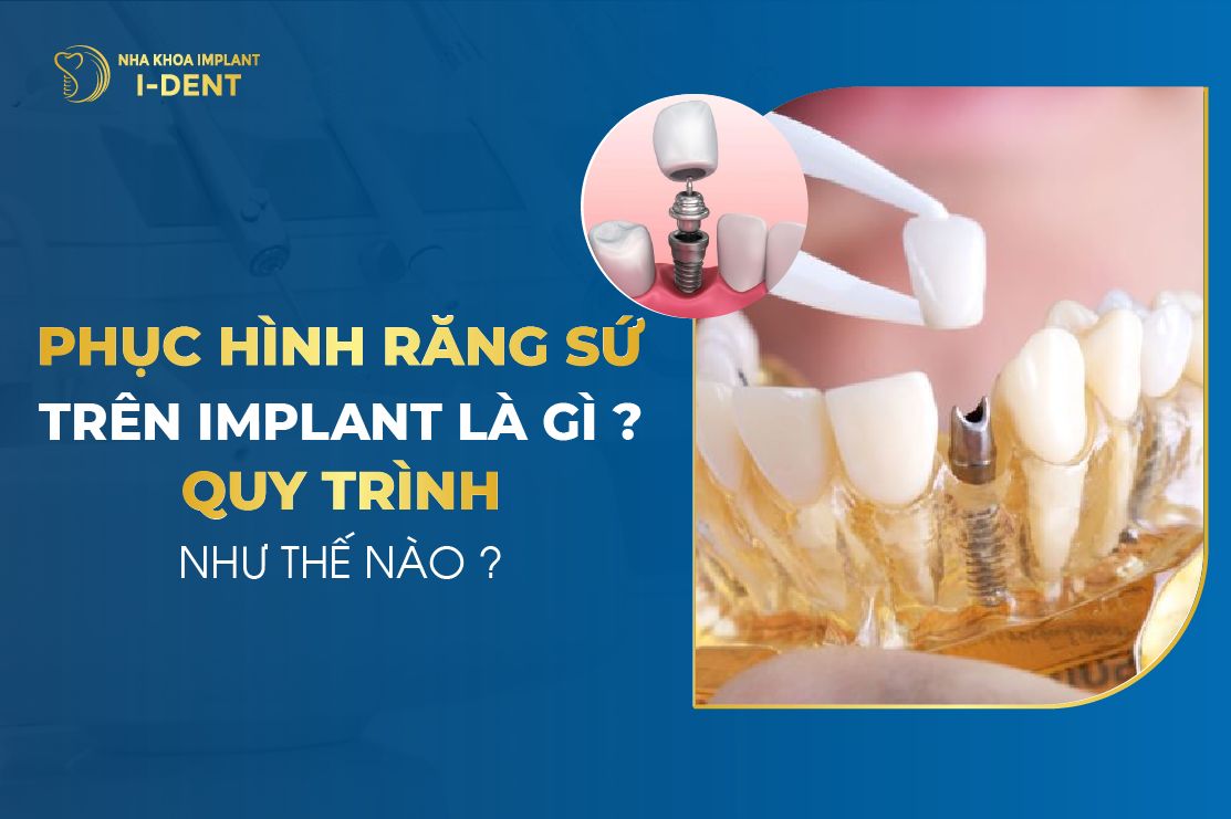 Toàn cảnh phục hình implant