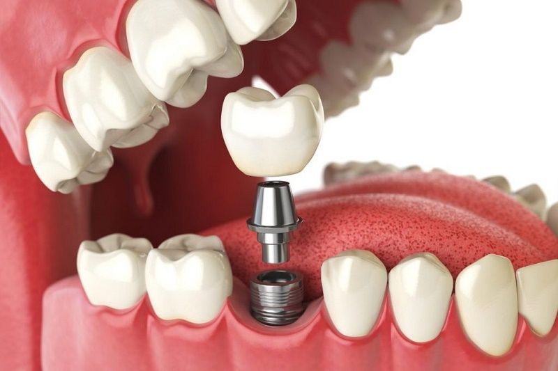 Trình tự cấy ghép răng implant