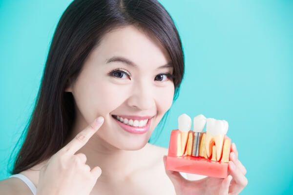 Chất lượng trụ implant