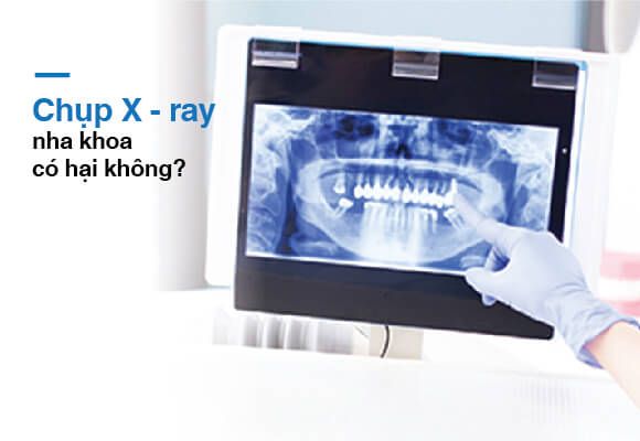 hinh-anh-xray-cua-nha-khoa